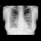 Wegener's granulomatosis: X-ray - Plain radiograph